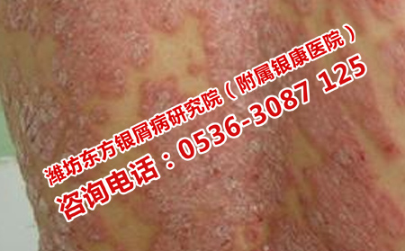 如何规避牛皮癣的复发性