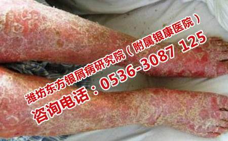 如何治疗全身牛皮癣