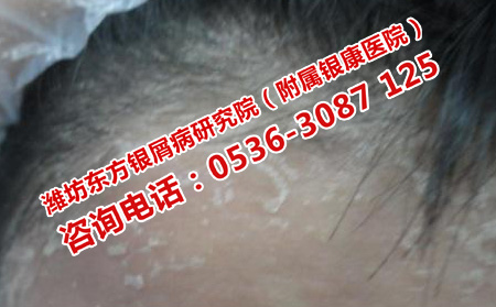 头部脱屑是牛皮癣的症状吗