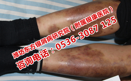 寒亭哪里看牛皮癣