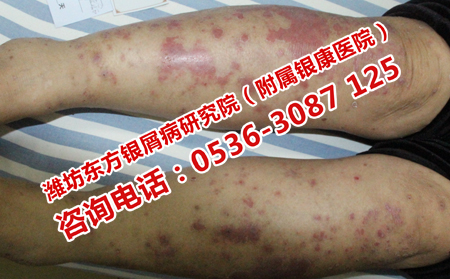 看银屑病可以的医院