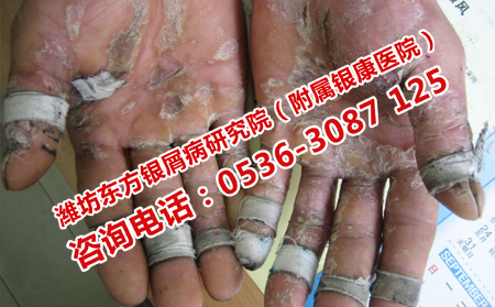 什么时候治银屑病可以