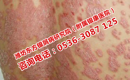 银屑病治疗的方法