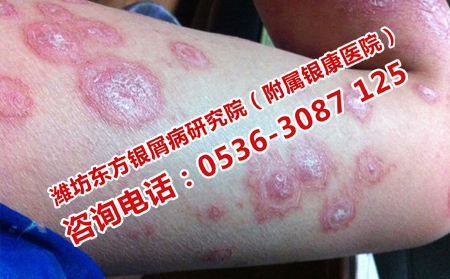 如何确诊银屑病的症状