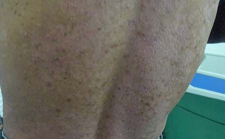 预防银屑病要远离哪些食物