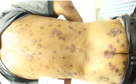 山东省潍坊用药不当会引发牛皮肤癣吗