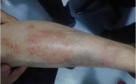 银屑病症状,银屑病的症状表现