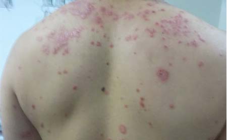 银屑病症状,银屑病大概症状表现