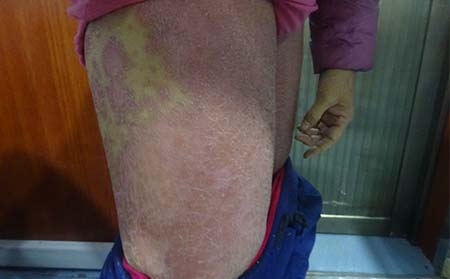 银屑病治疗,身上银屑病怎样防治