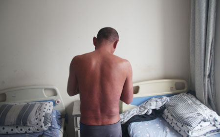 牛皮癣症状有什么