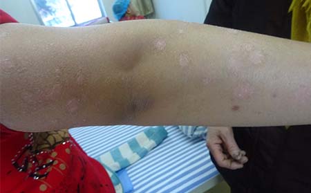 儿童牛皮癣早期症状,儿童牛皮癣症状表现