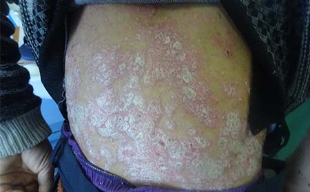 银屑病症状表现,银屑病典型症状表现