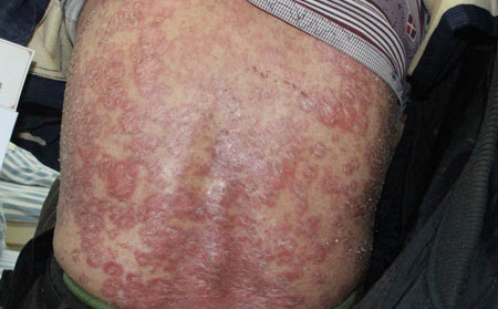 银屑病的治疗方法