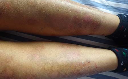 银屑病治疗费用