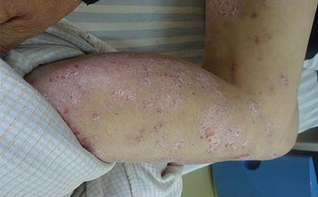 牛皮癣好转症状,牛皮癣好转有什么表现