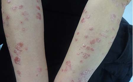 儿童银屑病症状,儿童初期银屑病症状