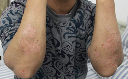 银屑病的危害有什么