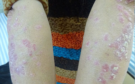 银屑病治疗方法