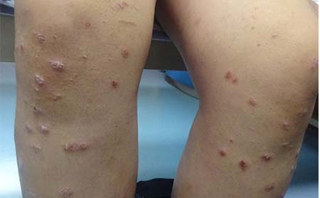 银屑病治疗费用