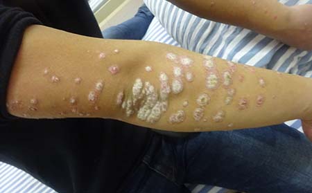 牛皮癣的一般症状,牛皮癣症状表现