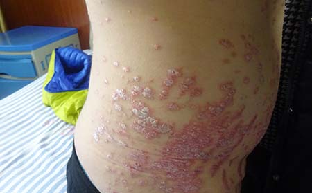 银屑病治疗方法