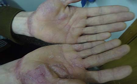 牛皮癣治疗费用