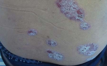 牛皮癣症状,怎样判断自己得牛皮癣