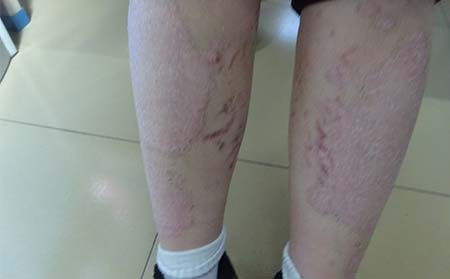 银屑病症状,银屑病常见症状