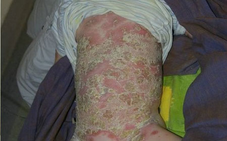 牛皮癣治疗方法