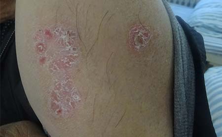 银屑病症状图片,银屑病症状什么样