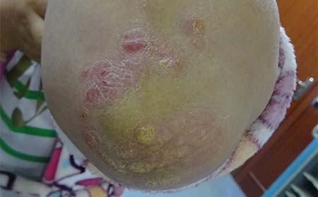 牛皮癣症状表现,得牛皮癣什么症状