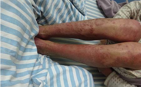 牛皮癣症状表现,牛皮癣一般有什么症状