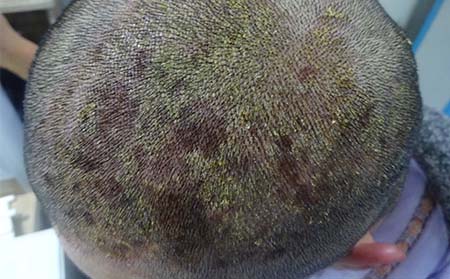 头部牛皮癣症状,头皮牛皮癣症状表现