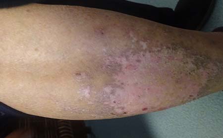 牛皮癣症状表现,牛皮癣典型症状