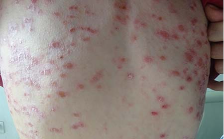 银屑病症状图片,银屑病有哪些症状表现