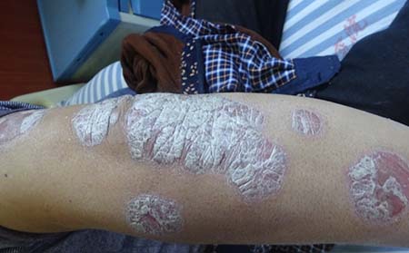 银屑病症状表现,银屑病皮屑什么样