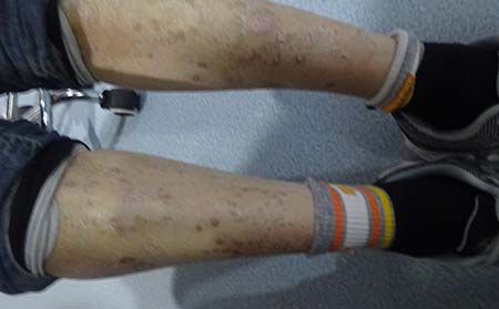 牛皮癣主要的症状,牛皮癣都有哪些症状