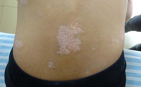 银屑病好转症状,银屑病快好什么症状