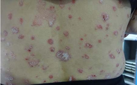 牛皮癣发病症状,得上牛皮癣症状表现