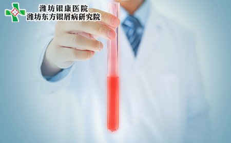 有牛皮癣怎样治,得牛皮癣要怎样治