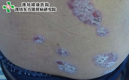 牛皮癣症状表现,牛皮癣前期征兆