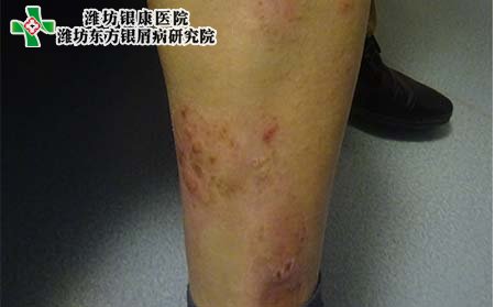 银屑病症状,银屑病有怎样的症状