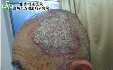 头部牛皮癣注意,头上有牛皮癣注意事项