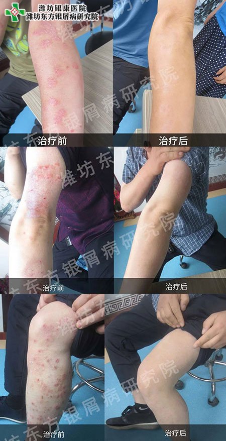 潍坊东方银屑病研究院牛皮癣银屑病治疗康复对比图