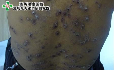 老年银屑病症状,老年患银屑病症状