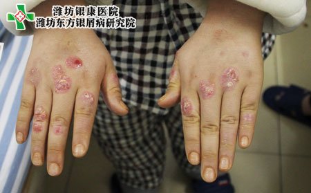 手部银屑病症状,手部银屑病症状表现