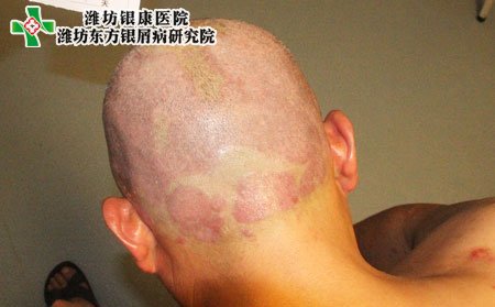 银屑病症状表现,全身银屑病症状