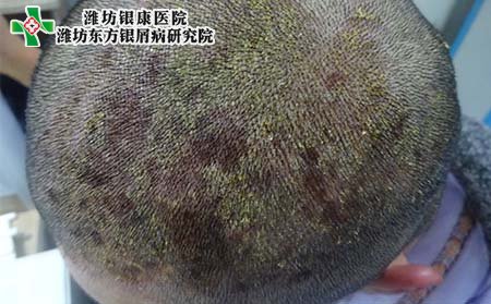 头部牛皮癣护理,怎样护理头部牛皮癣