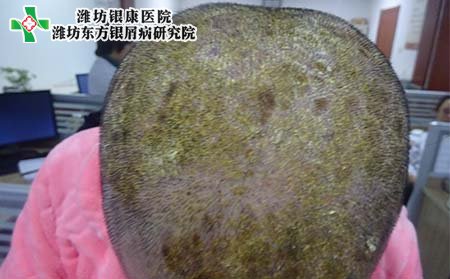 头部银屑病症状,头皮型银屑病症状