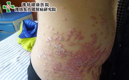 牛皮癣症状表现,怎样诊断牛皮癣症状